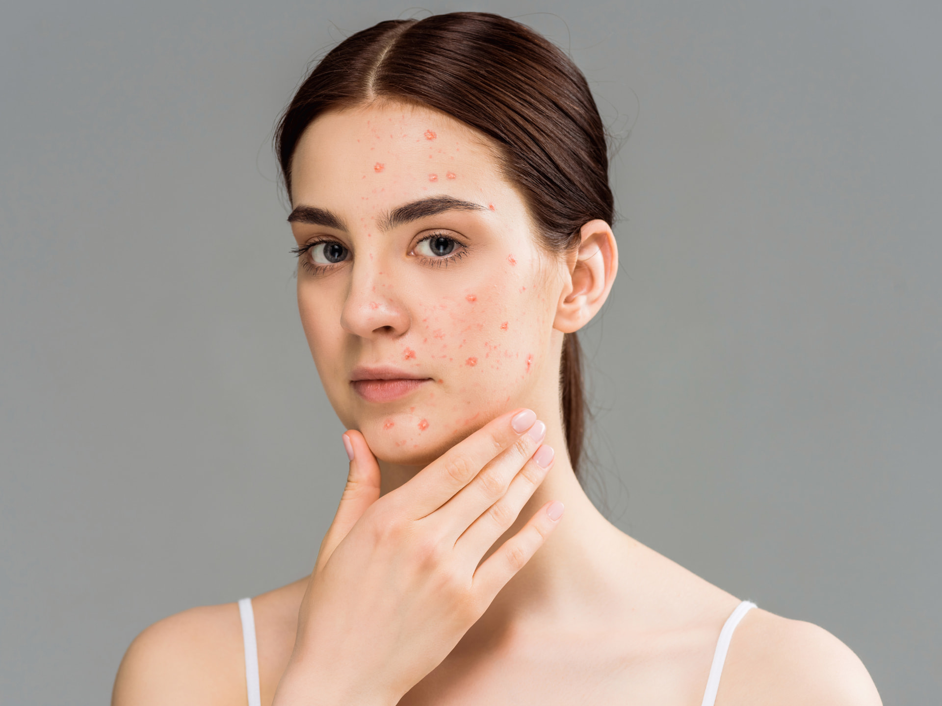 Prontomed Skin Balance akut gegen Pickel